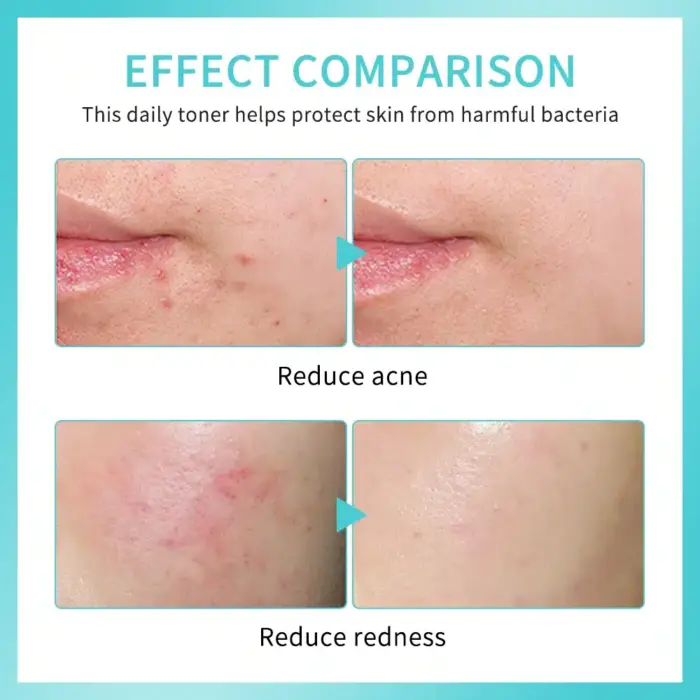 Reduce Redness Toner - Image 4